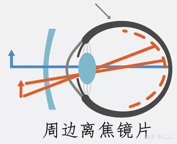 眼科医生的近视防控“神器”:离焦眼镜 - 知乎