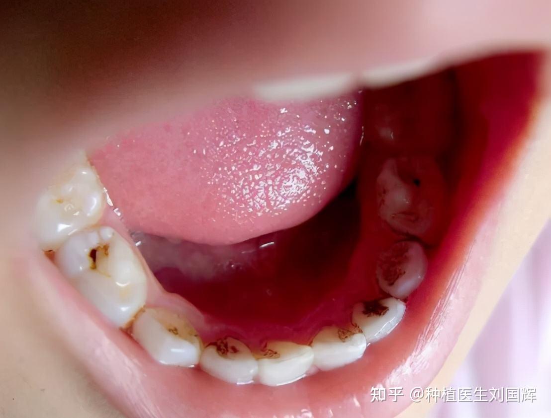 Ask.DentistMY 牙牙学医: Ask.Dentist牙牙学医: What is gum disease? 什么是牙龈疾病？