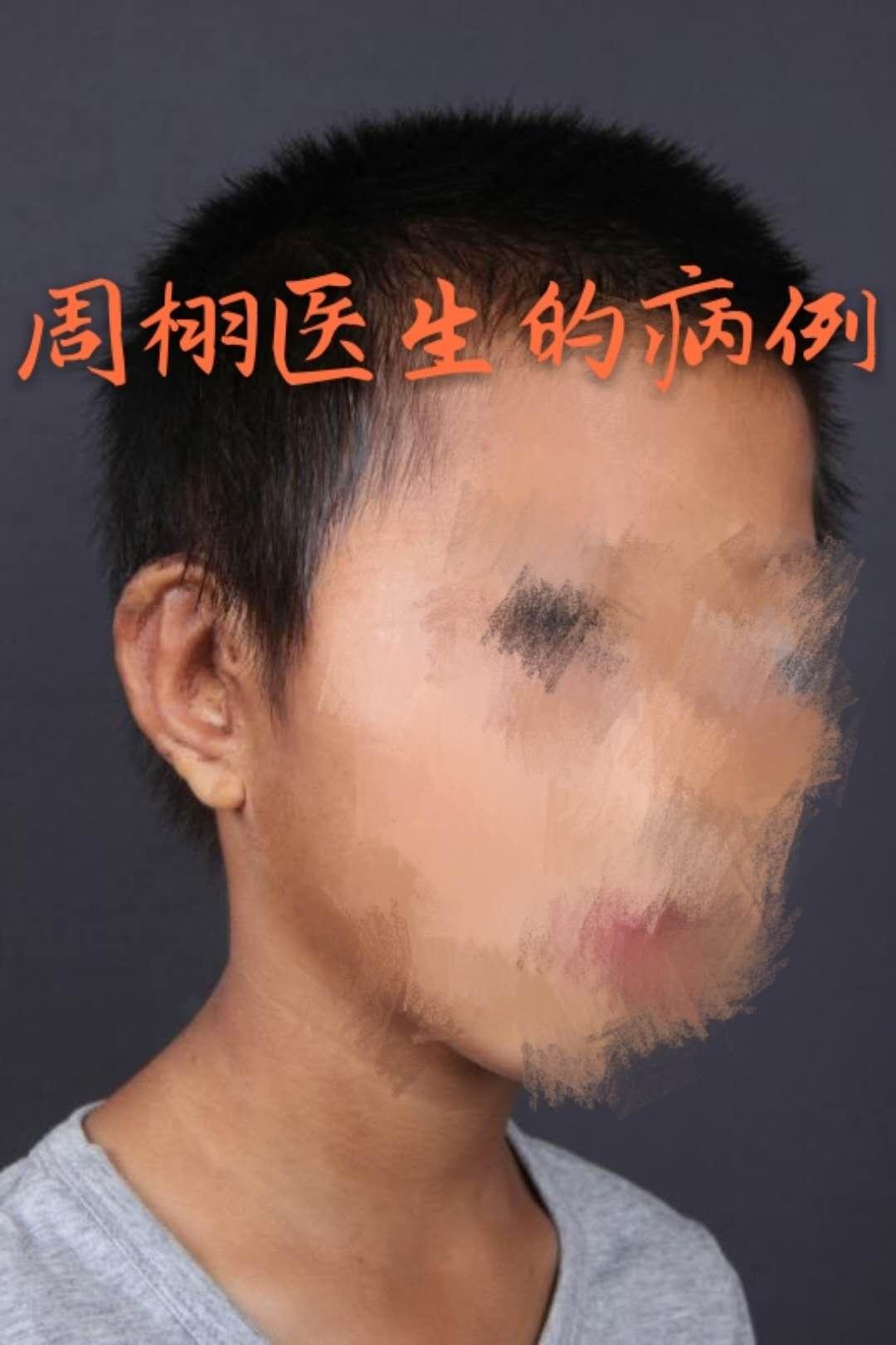 耳朵再造手术能报销吗_耳朵重造手术_耳朵再造术的价格
