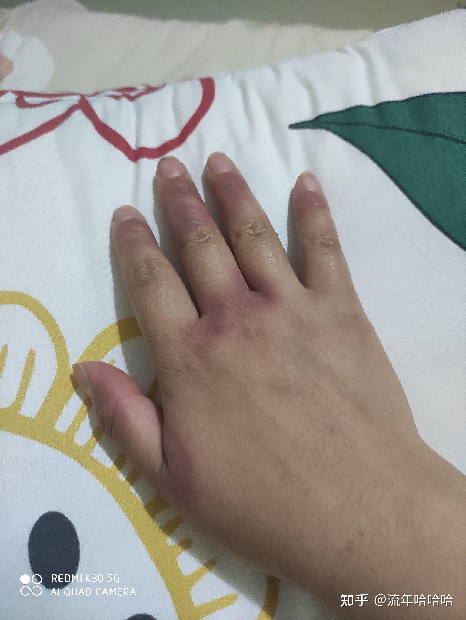 得了白塞病的我.真的很绝望