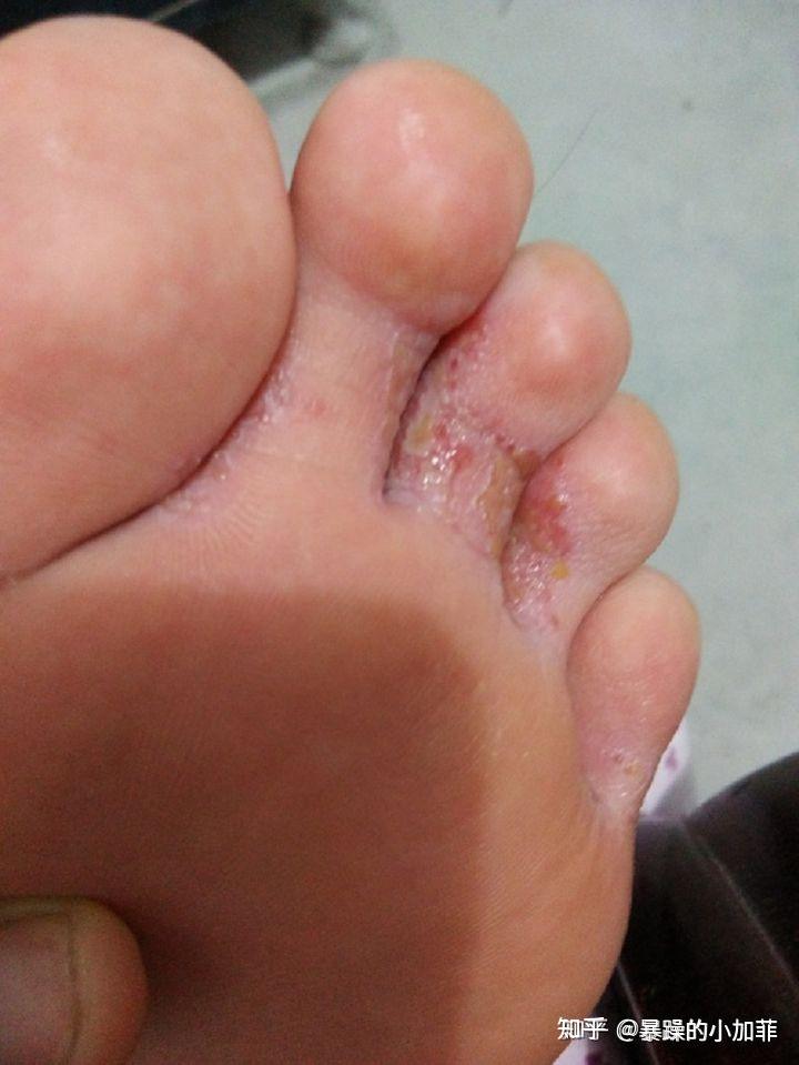 关于脚气脚臭脚痒,和你们说说我的看法!