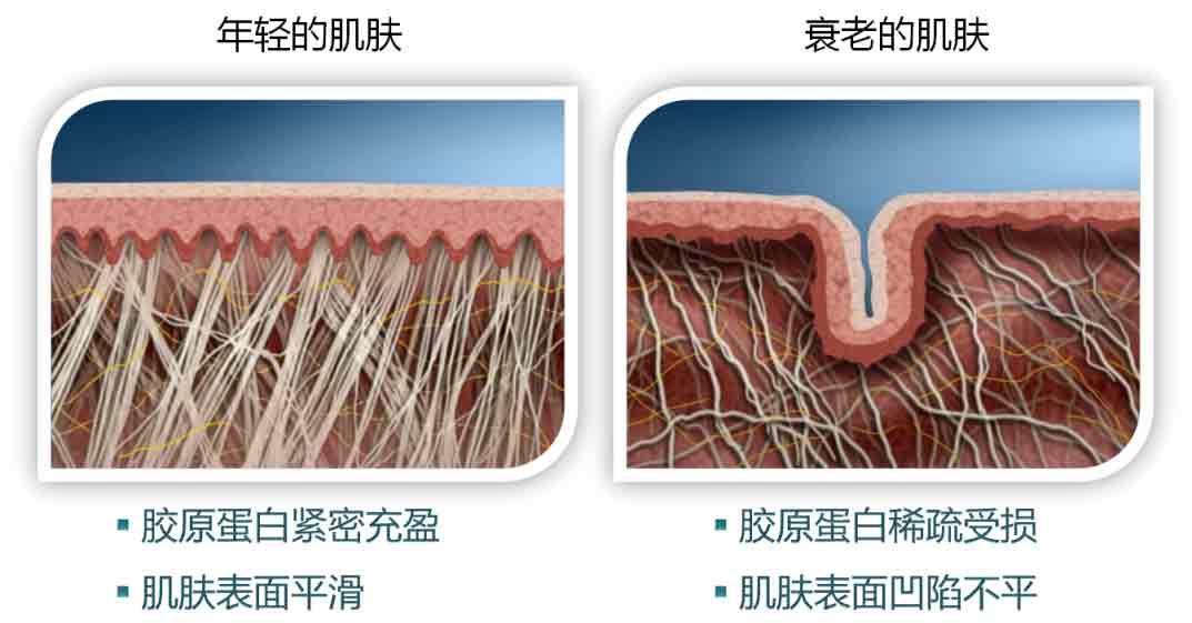 皮肤衰老过程示意图图片