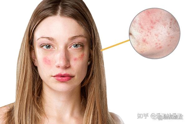 换季敏感泛红干痒红血丝加重皮肤又双叒叕出问题