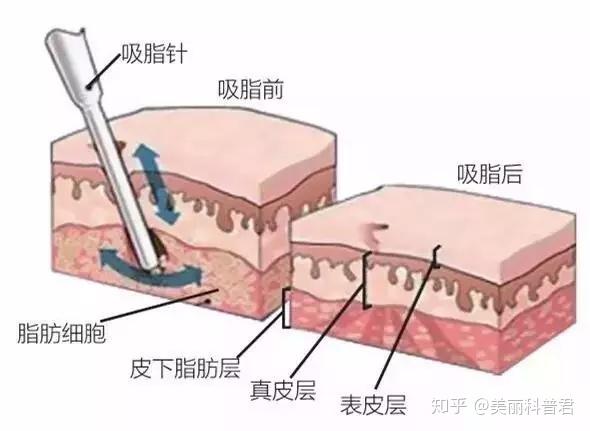 肉肉女生减肥除了节食健身 还有哪些效果好的方式 知乎