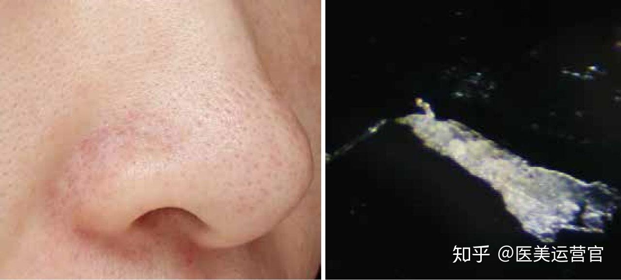 黑头白头护理三部曲