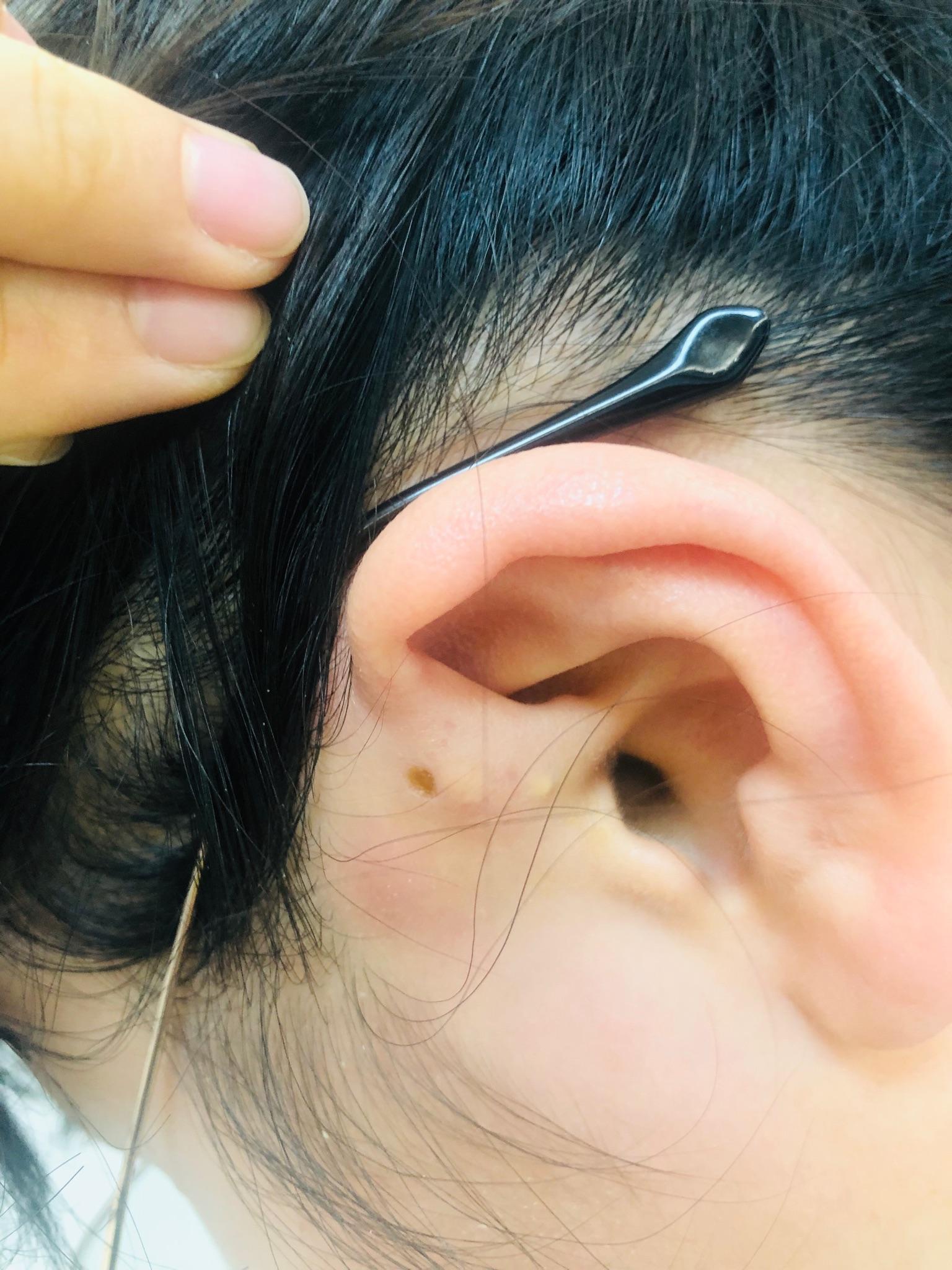 耳の湿疹 左 - ヒフ・ファイター