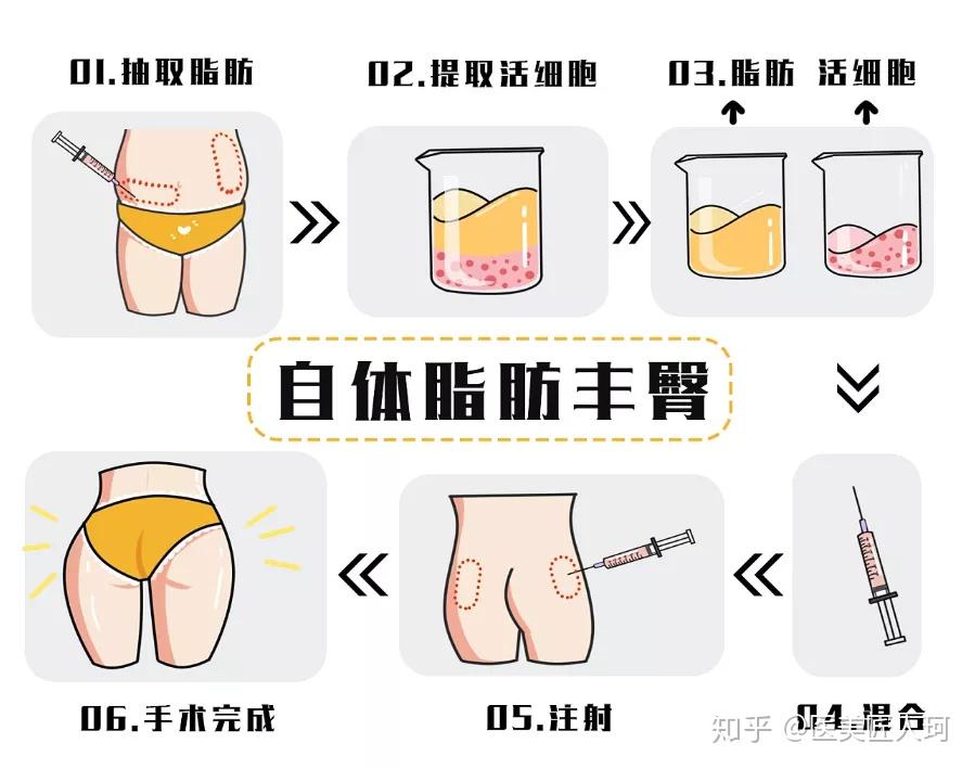 脂肪丰臀适用人群1, 臀部局部凹陷者2, 臀部下垂者3, 臀部脂肪堆积者4