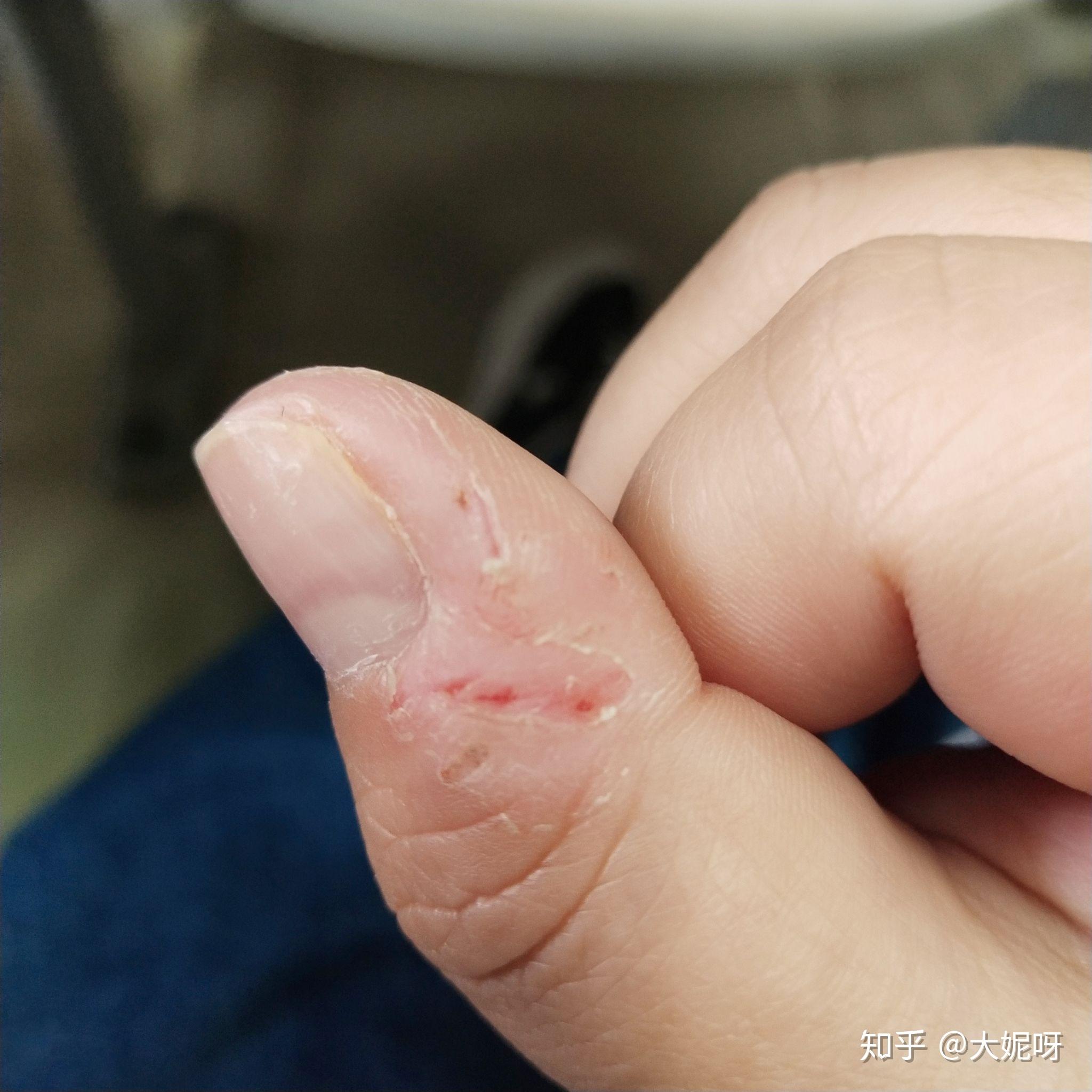 我朋友焦虑的时候总是喜欢扣手两只手的大拇指都抠破了很严重看着很