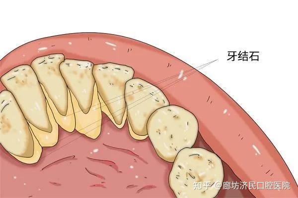 有牙结石该怎么去除？教你清除牙缝中的“小石头 知乎 4358