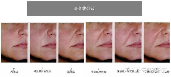 如何快速去掉法令纹？玻尿酸、超声炮、欧洲之星哪种改善最有效？ - 知乎