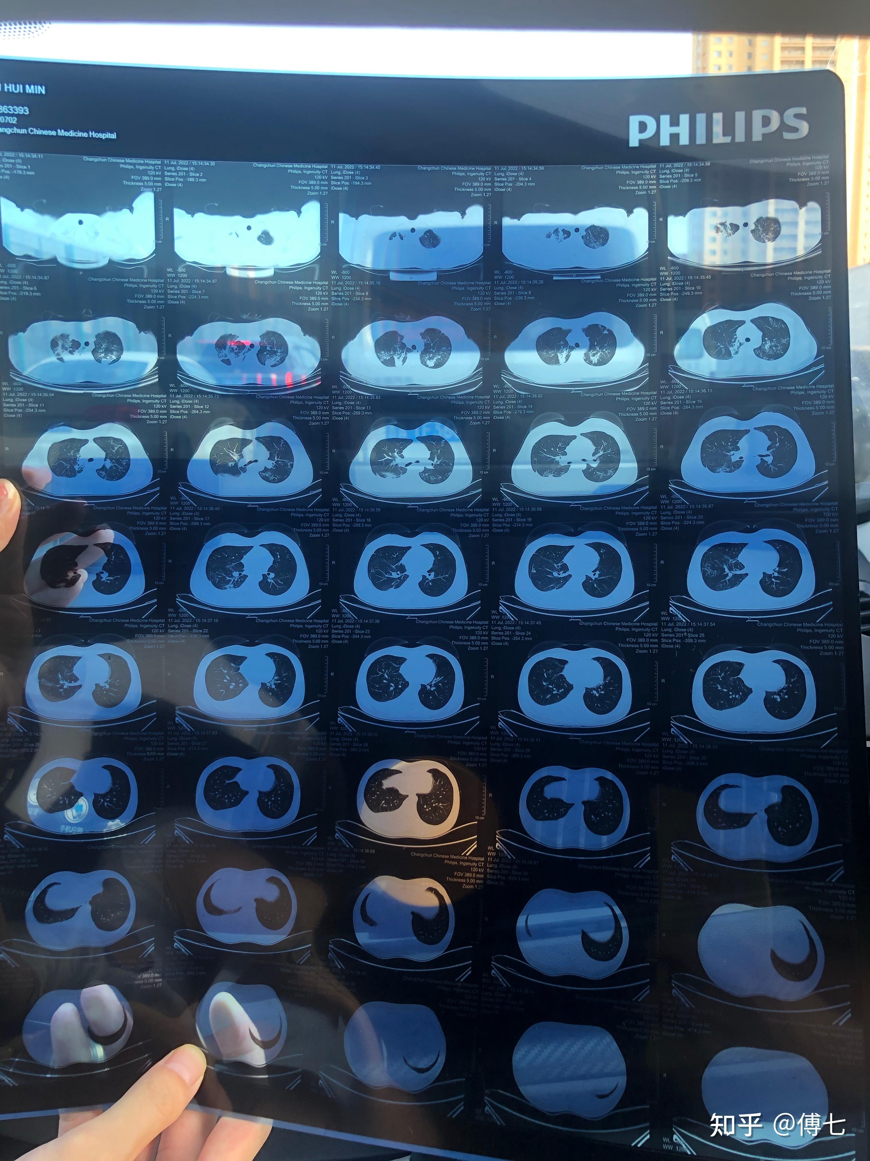 肺结核胸膜炎患者求助 - 知乎