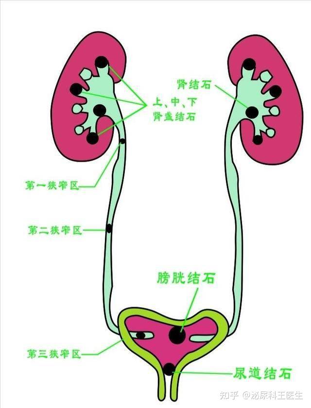 肾结石结构图图片