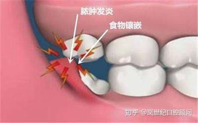 什么是智齿冠周炎? - 知乎