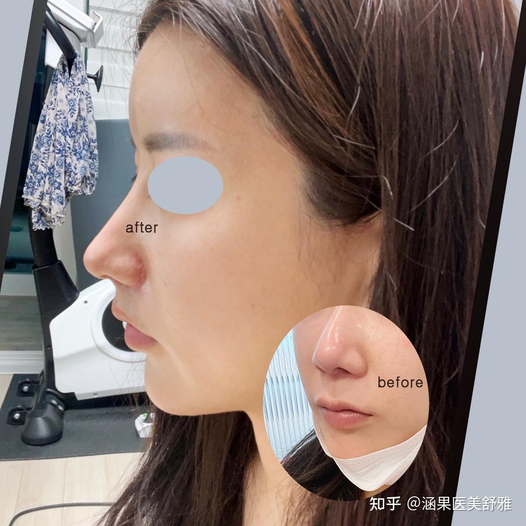 郑博士的3d无痕人中缩短是怎么做的