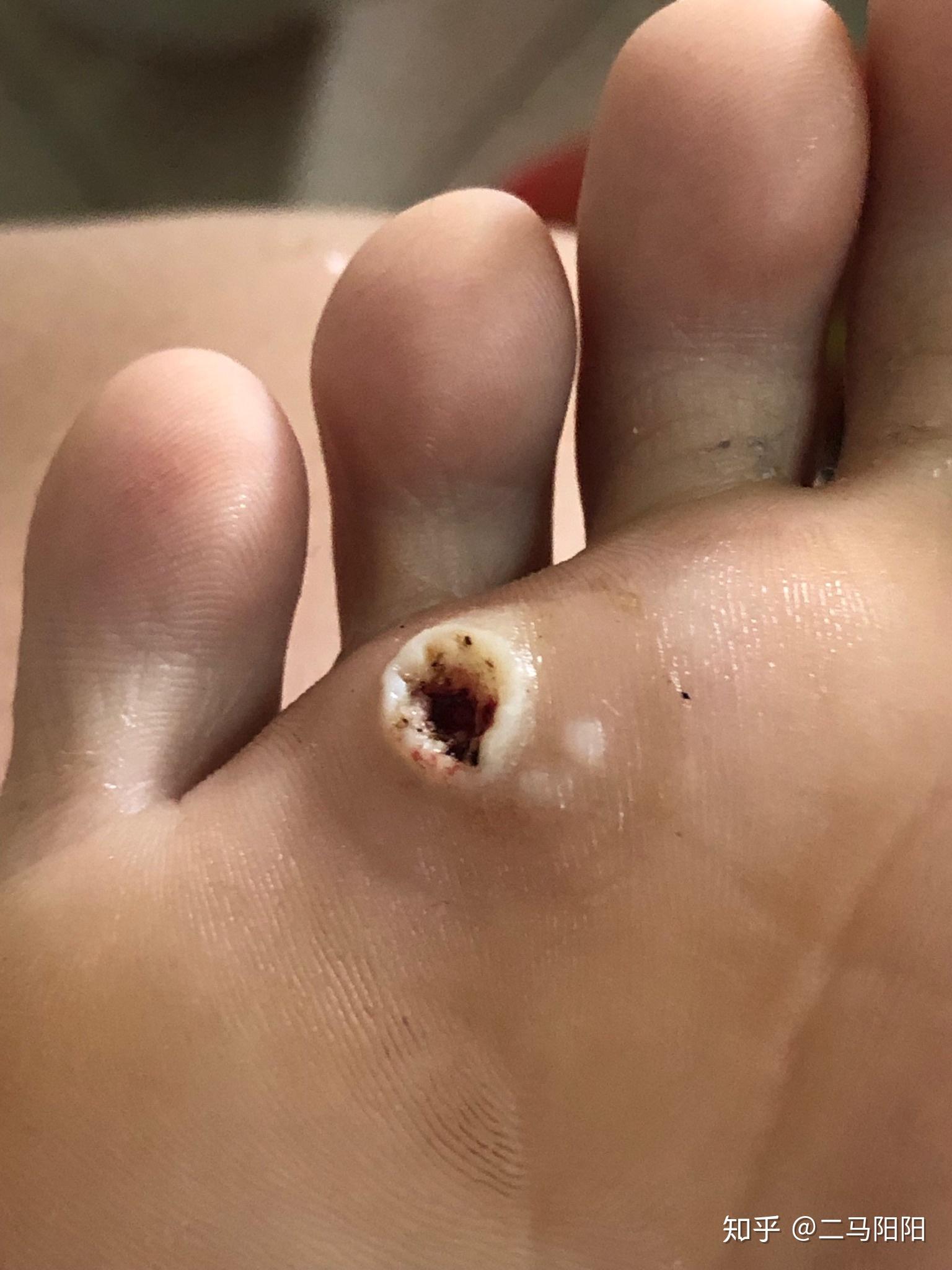 历时半年我是如何治好趾疣的