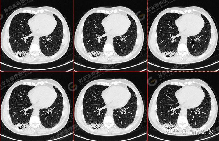 pet/ct病例—肺粘液腺癌,历经3年余终确诊【西安高尚医学影像诊断中心