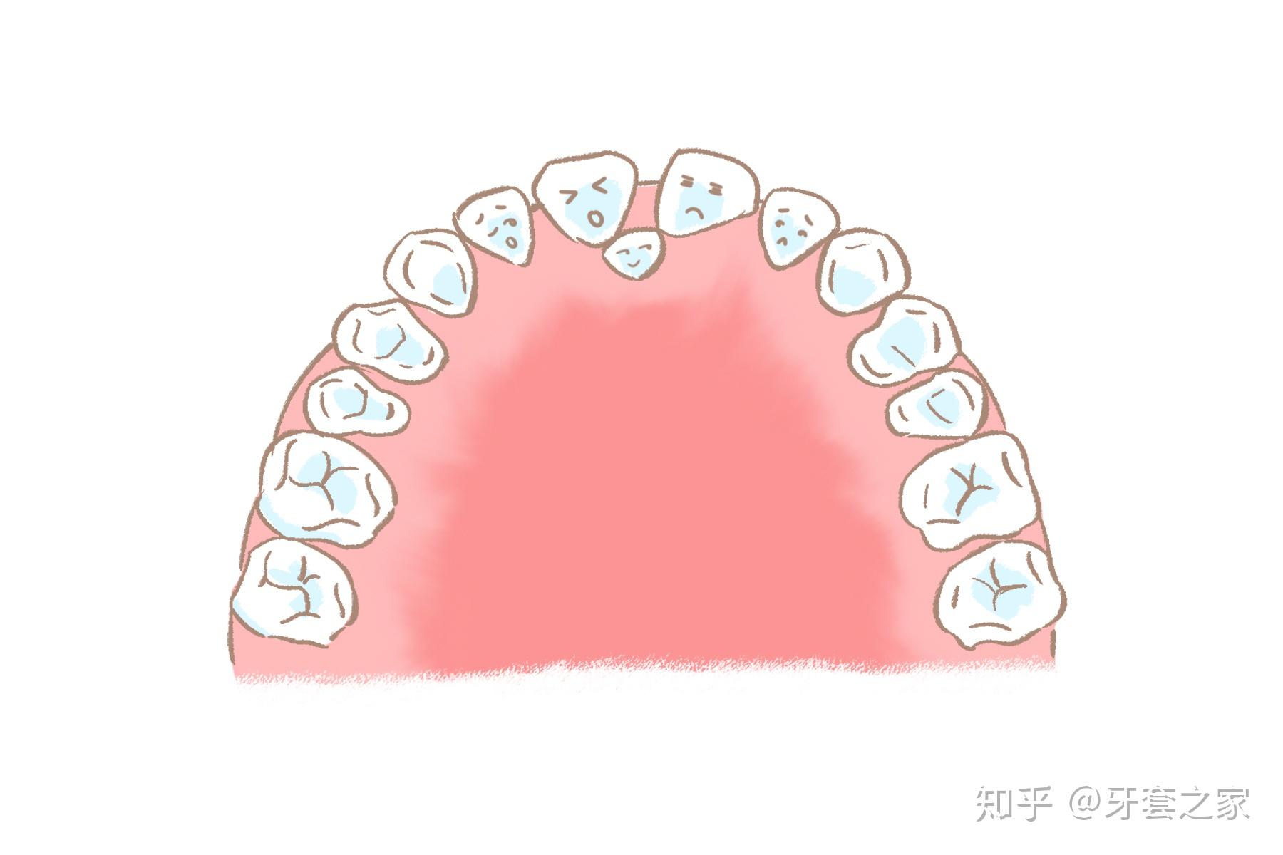 如唇顎裂合併牙齒畸形;舌繫帶發育異常,乳前牙外傷,牙齒齲壞,小兒疾病