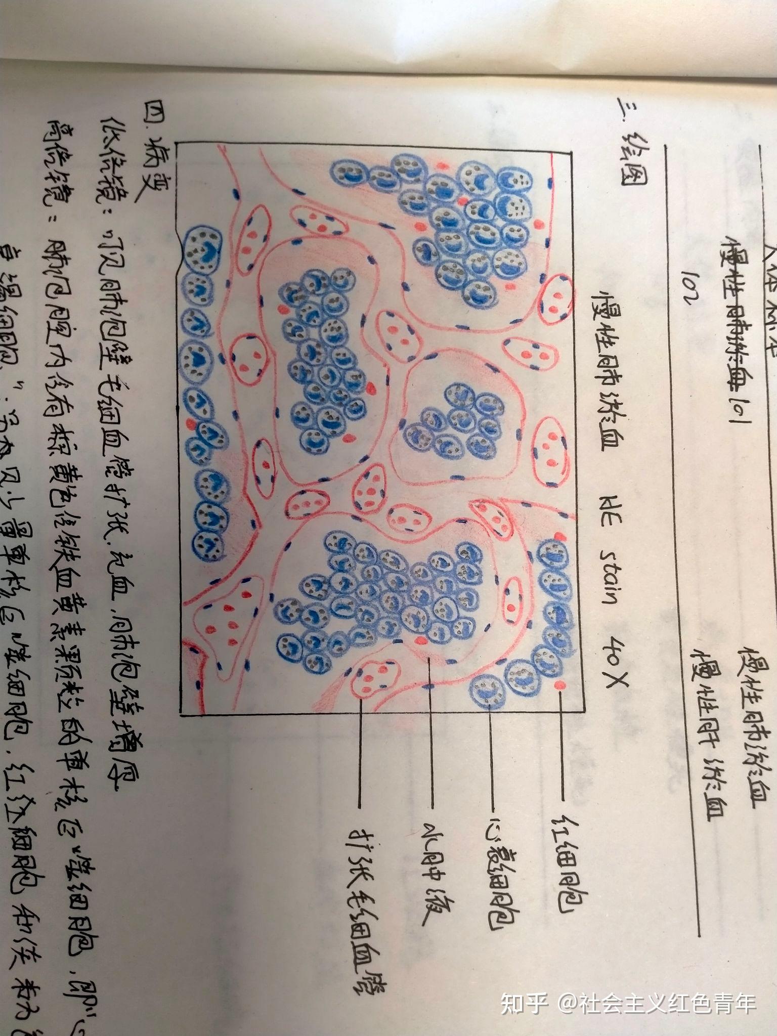 肺淤血红蓝铅笔图片