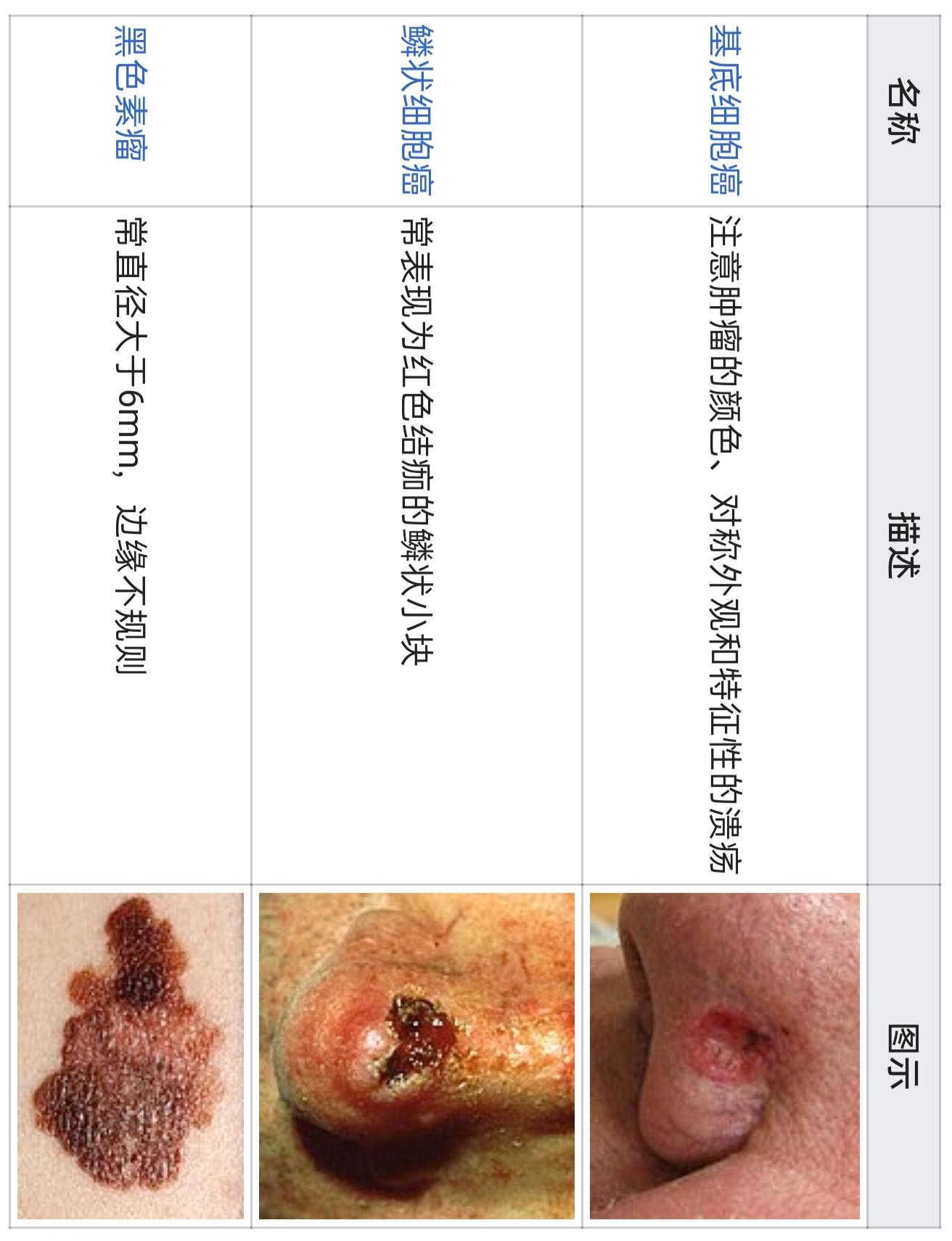 肛门鳞状细胞癌图片