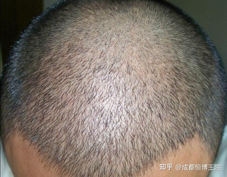 植发后的头发跟正常的头发有区别吗??? - 知乎