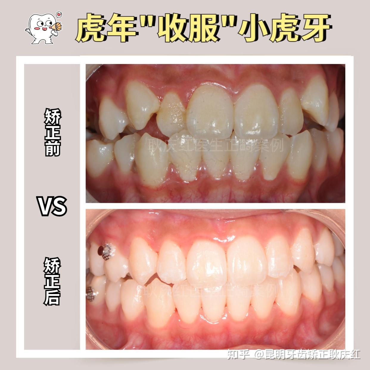 笑起来不好看,下排牙齿不整齐,上排牙齿有两颗虎牙,也不整齐. - 知乎