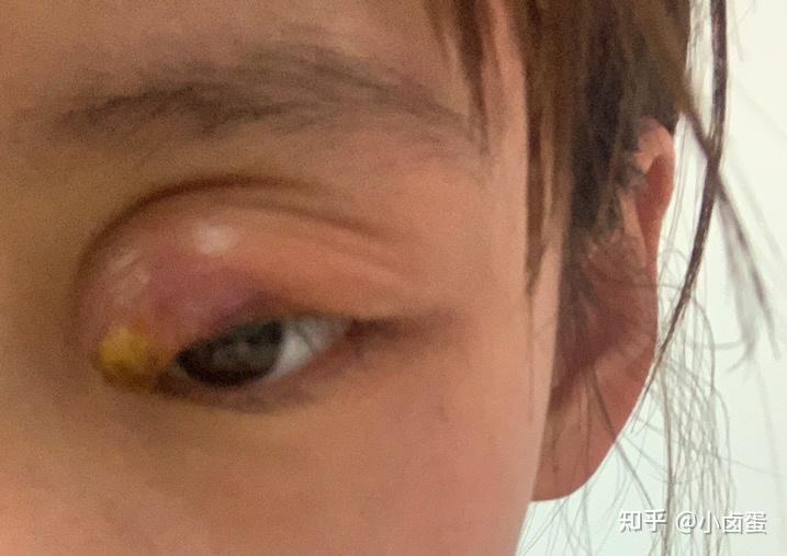 记录我的麦粒肿