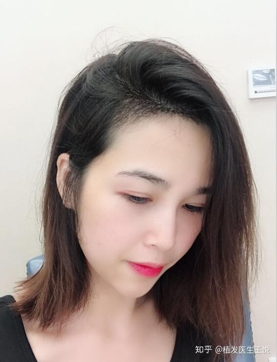 作为女生你是怎样变秃的?