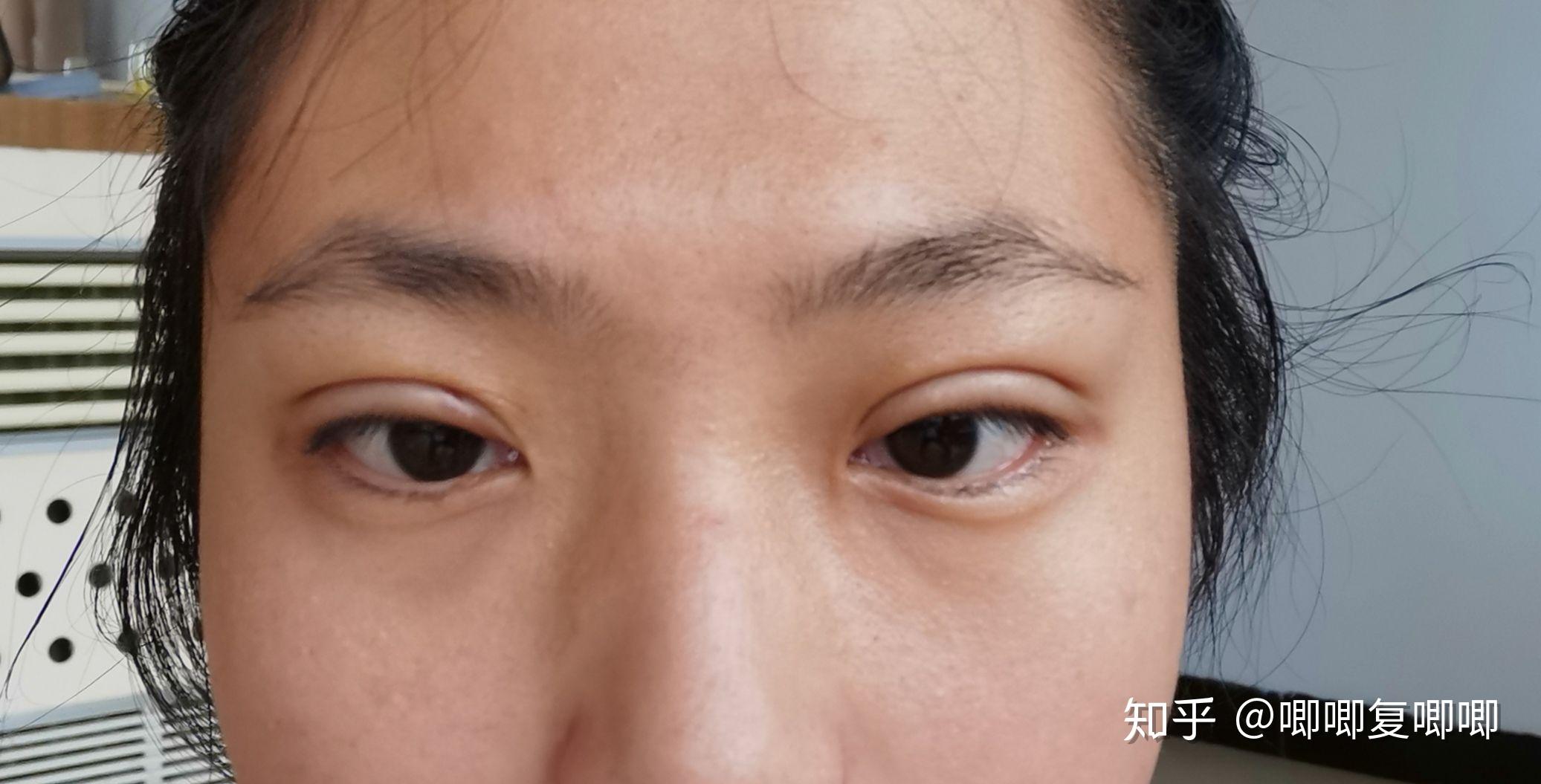 三点定位双眼皮记录