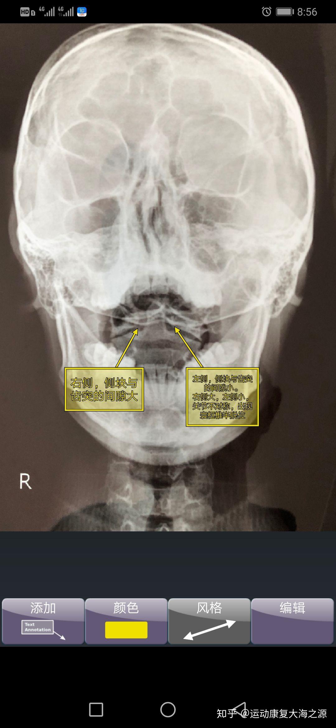 小儿寰枢椎半脱位图片图片
