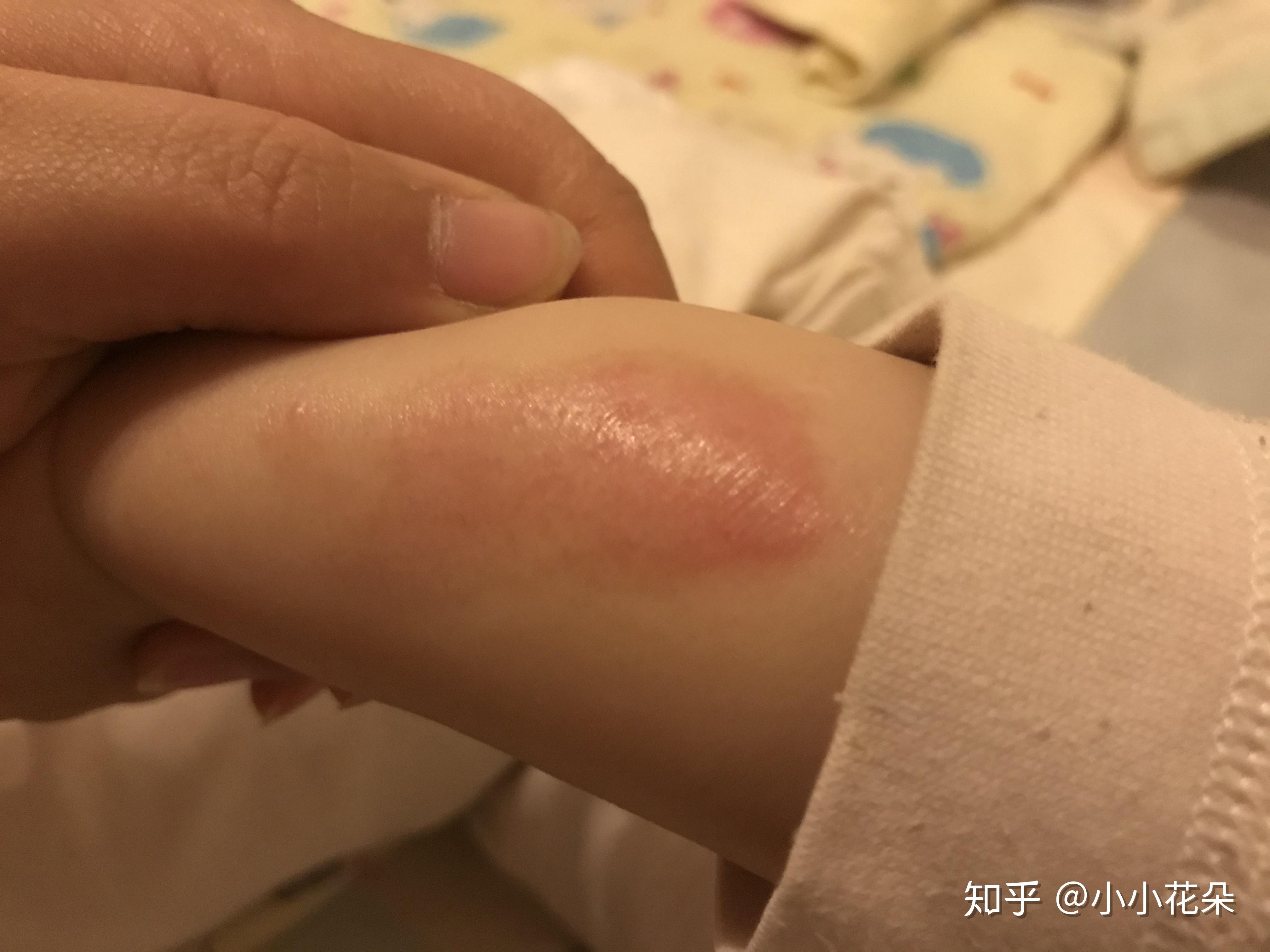 记录宝宝烫伤恢复和抗疤过程