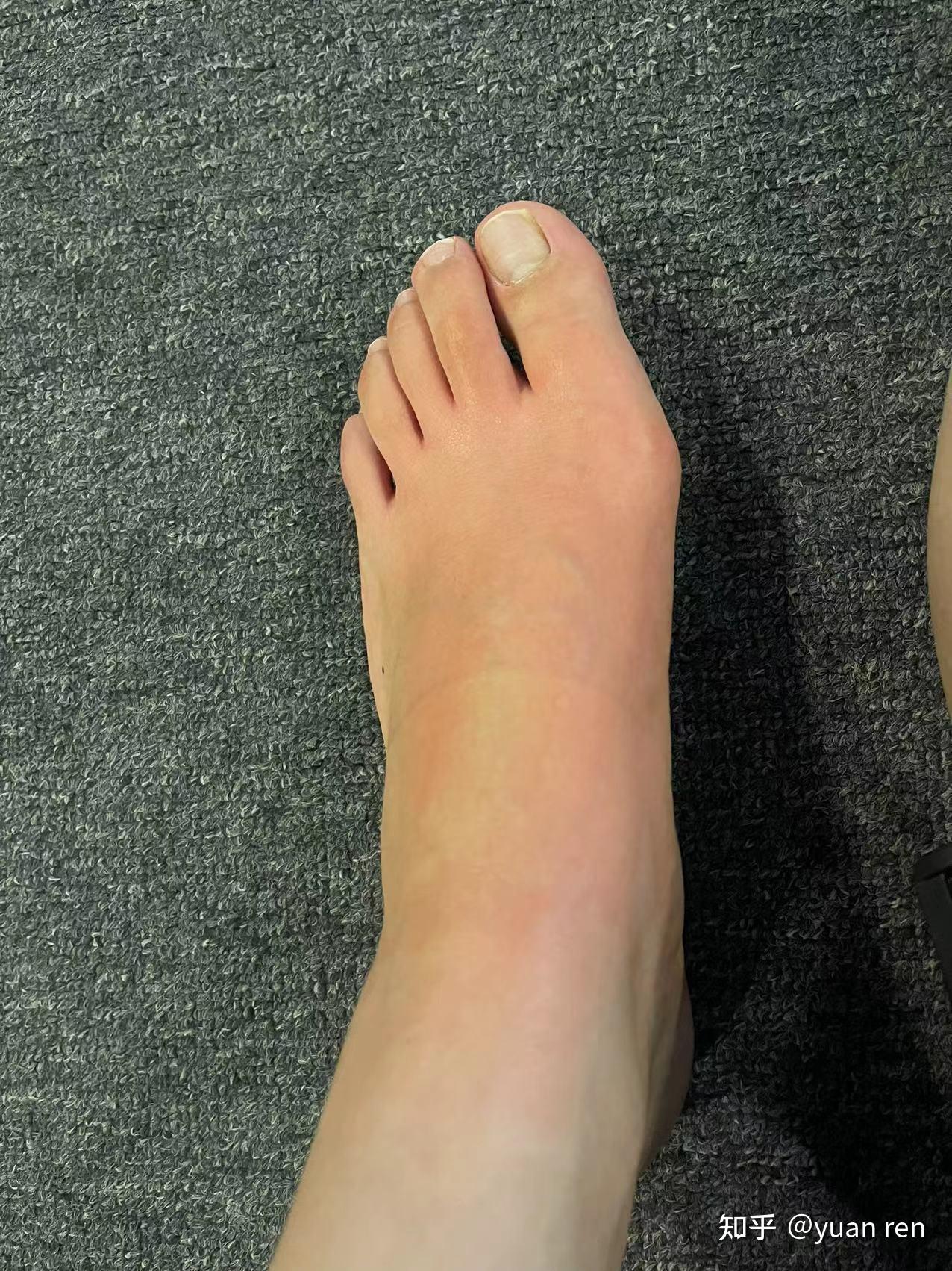 左足lisfranc损伤记录