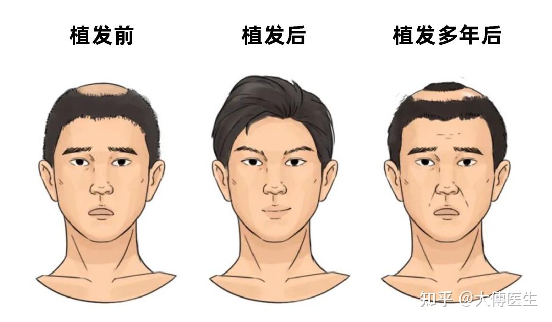 哪里做植发比较好(哪里可以做植发手术费用)