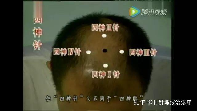 靳三针30组穴位(图文并茂) - 知乎