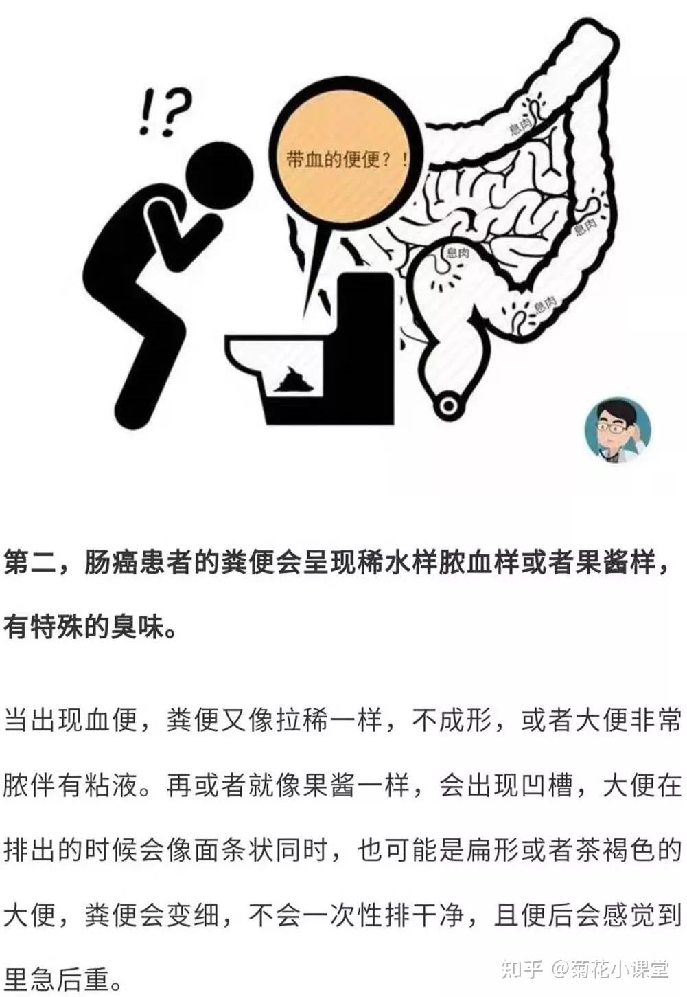 肠癌患者血便的颜色会发黑发红,在大便的隐血试验中多为阳性