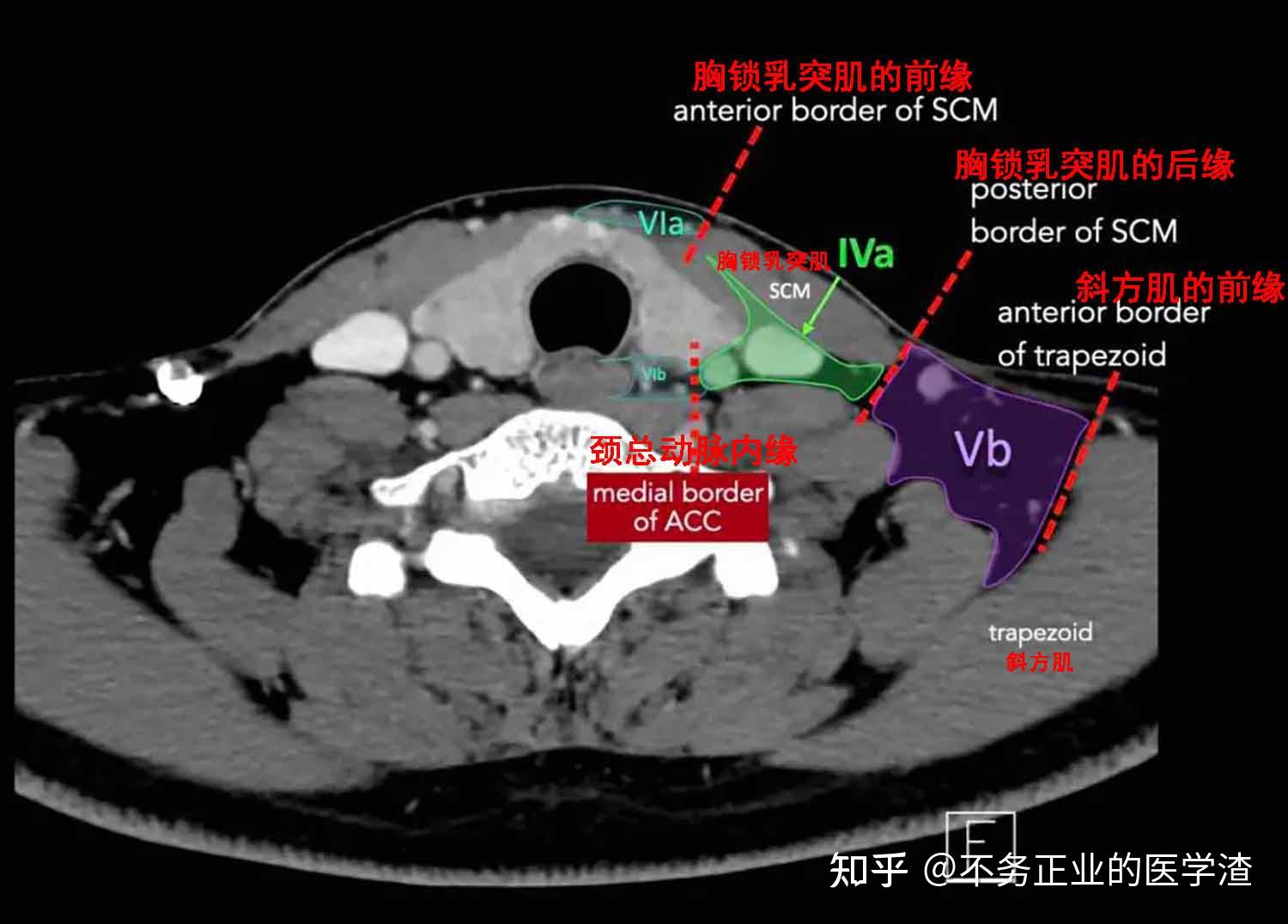 内乳淋巴结ct片图解图片