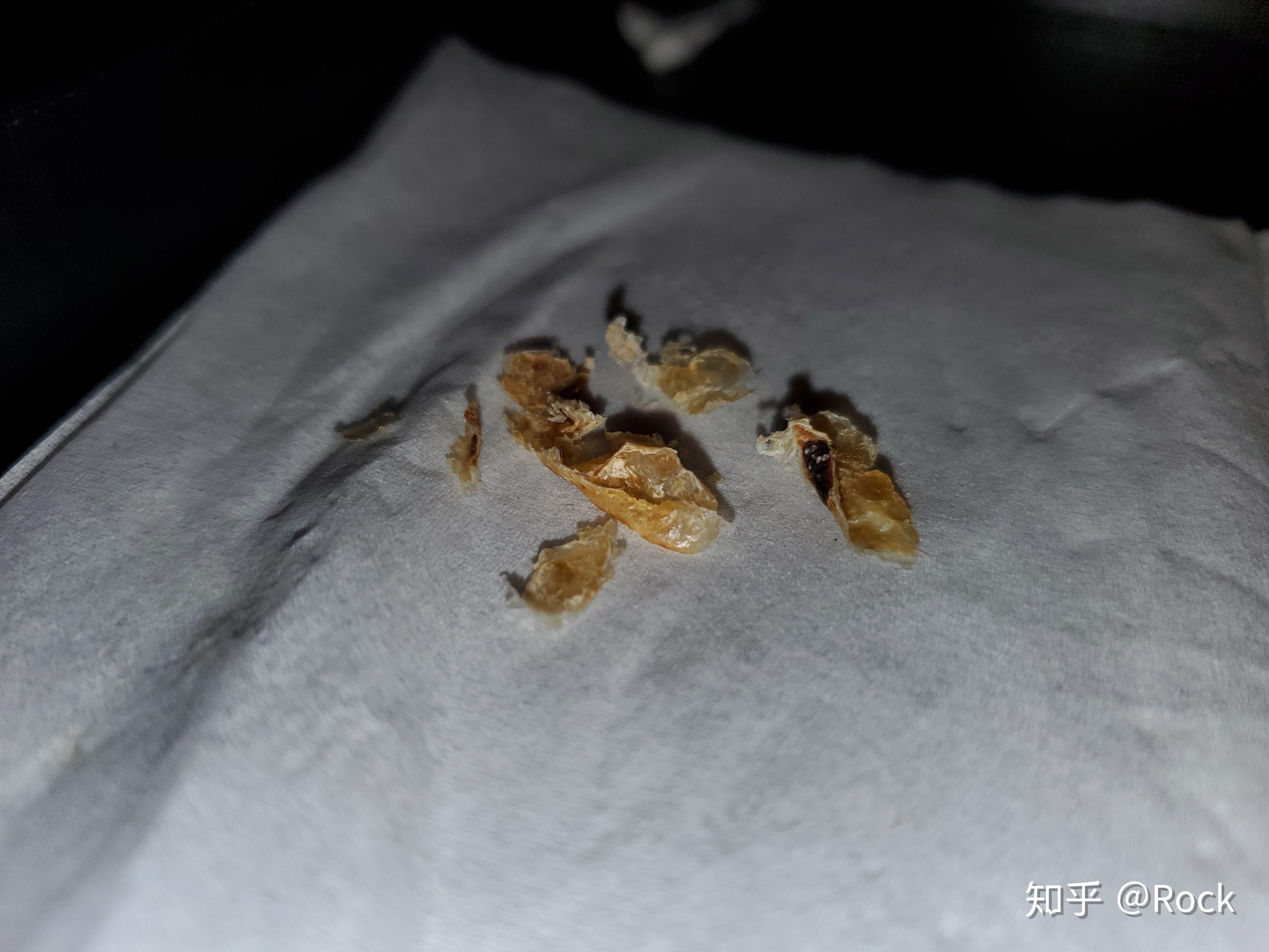 干片真菌耳屎图片