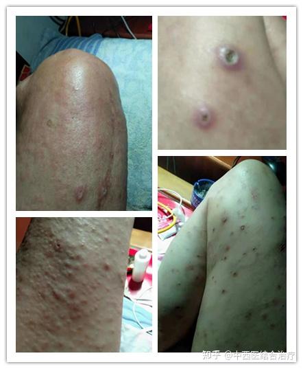 免疫系统皮肤病瘙痒的厉害怎么治疗?