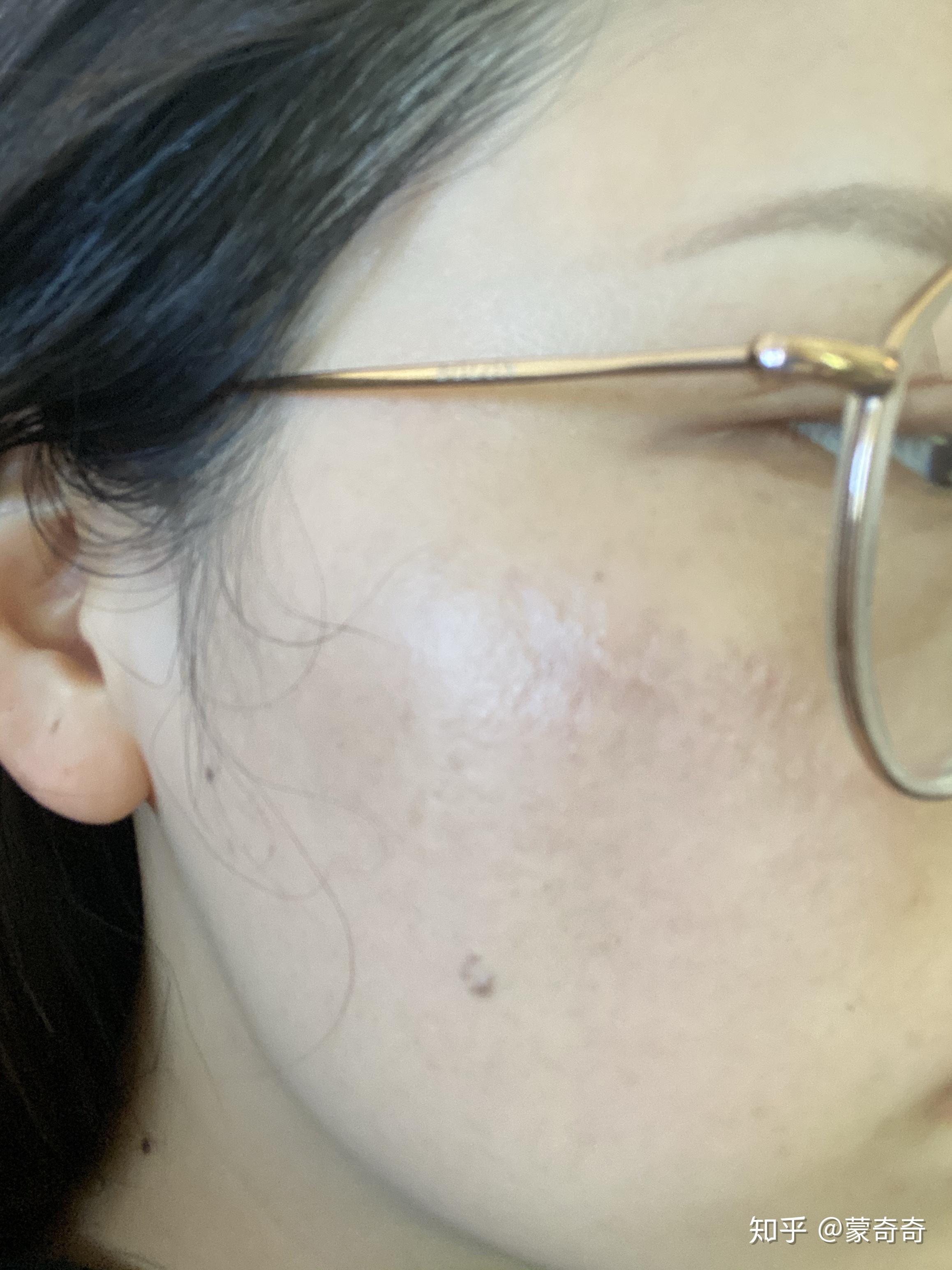 面部疤痕色素沉淀怎么消除 能用激光去除吗？ | 说明书网