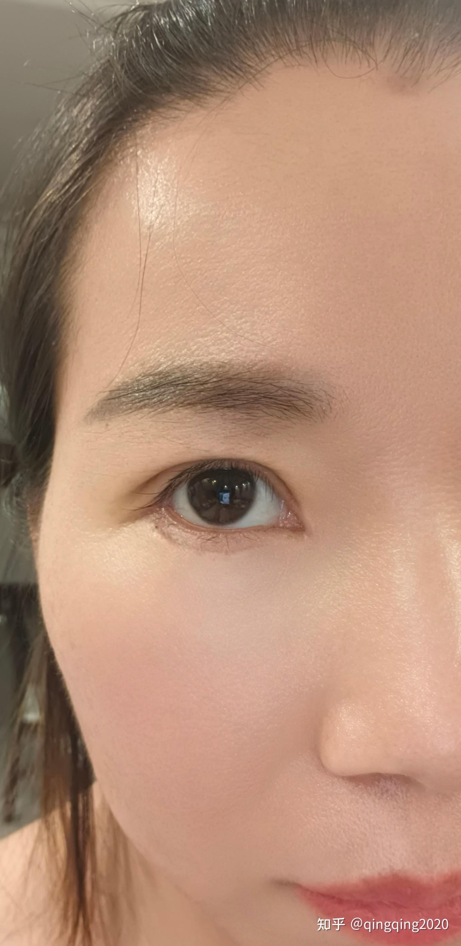 辛苦大家帮忙看看我这双眼皮做的是不是太窄了? - 知乎