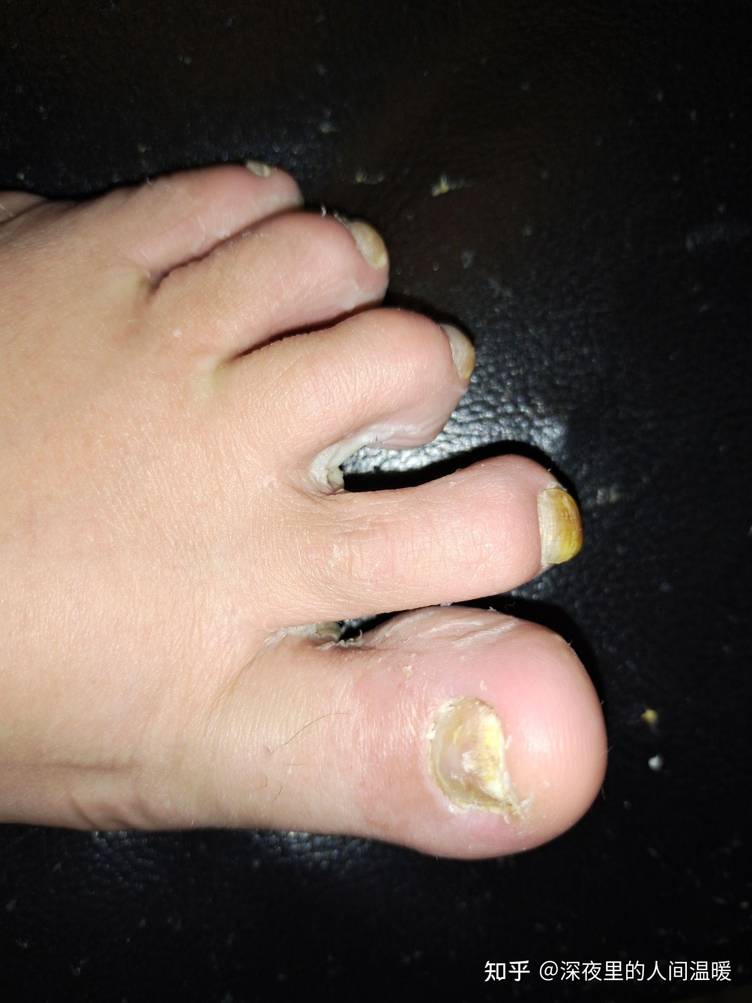 灰指甲2021年1月