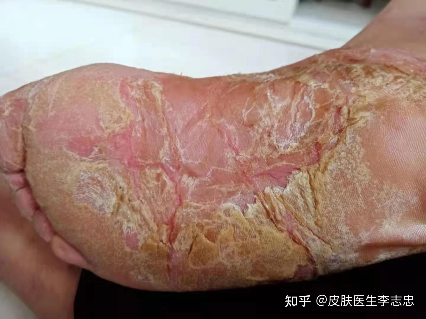 从寒湿理论角度治疗掌跖脓疱病用五积散治疗