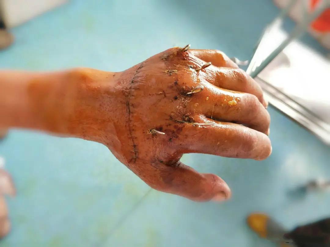 手部肌腱缝合术后恢复的五大方法!