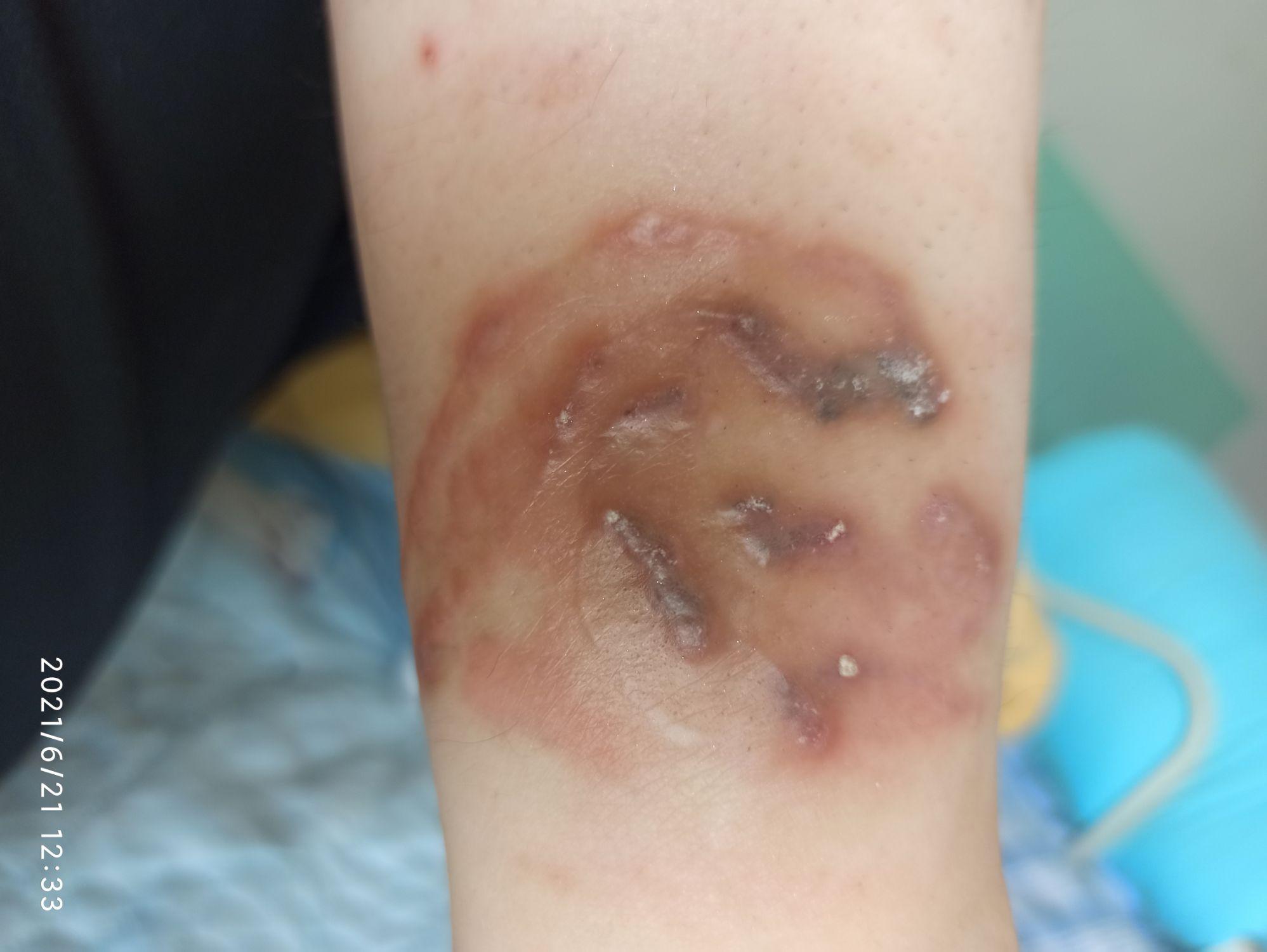 我也来发一下我洗纹身的时候