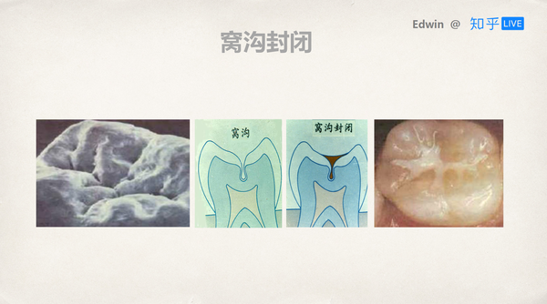 如何从小到大保护好牙齿?