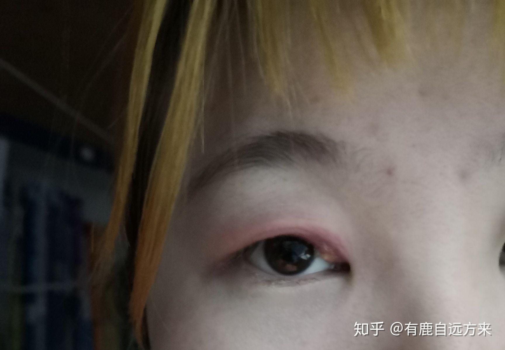 我与麦粒肿的斗争史