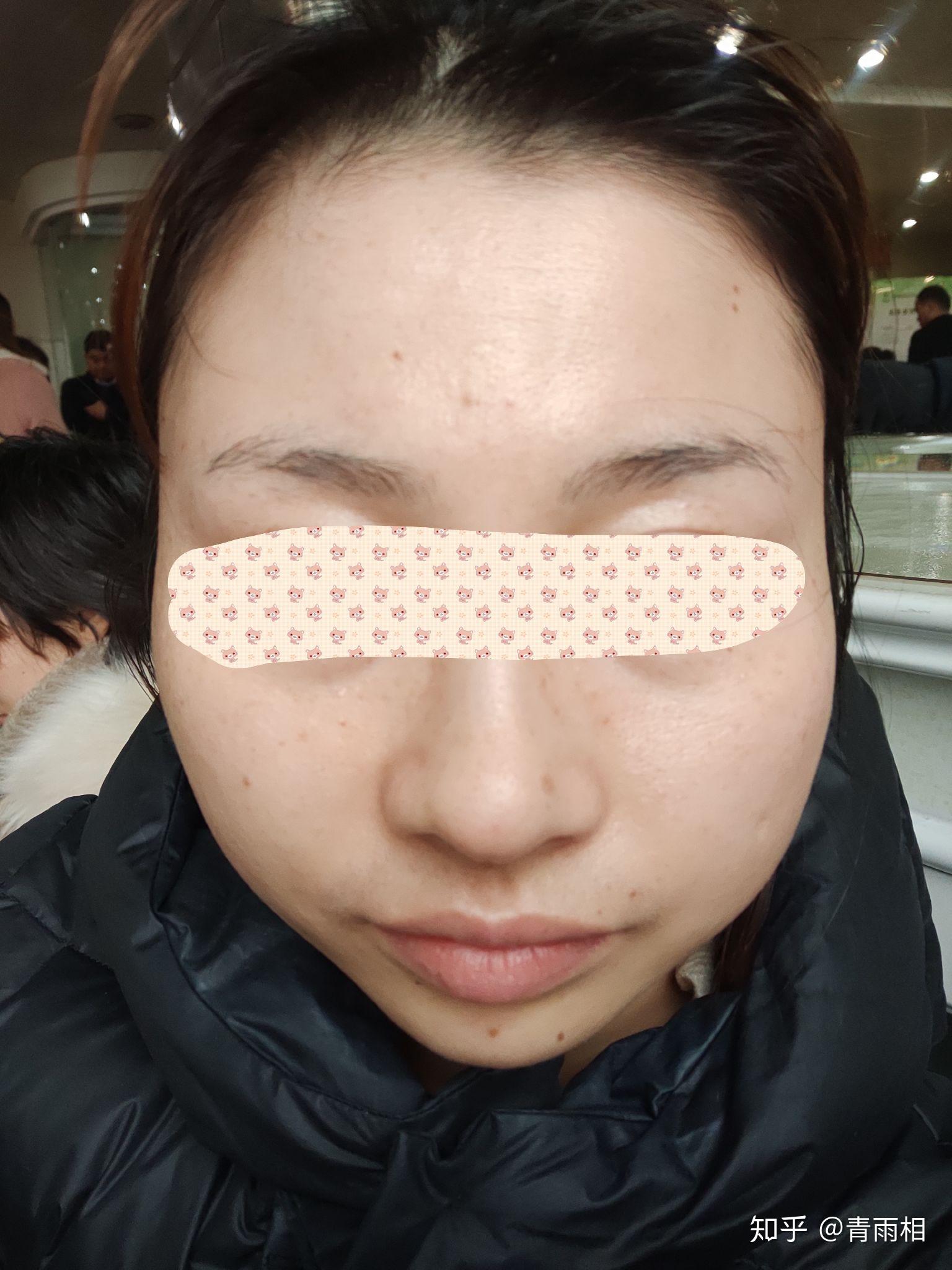 西京医院皮肤科激光祛斑经历 - 知乎