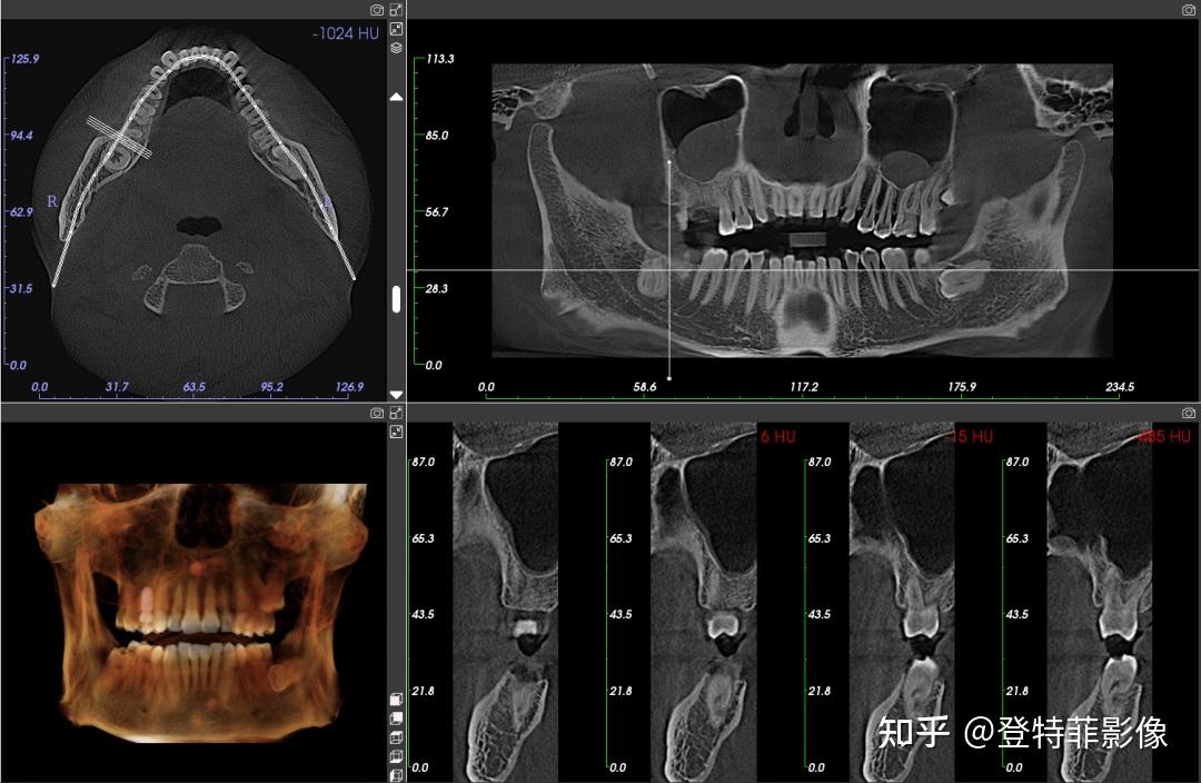 口腔cbct成像有大有小到底该怎么选