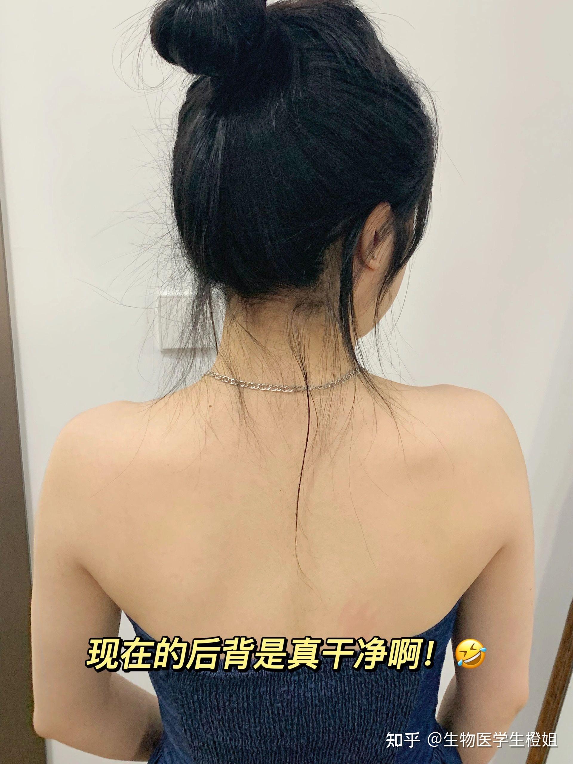 头皮掉发严重,头皮屑满天飞?这都是螨虫滋生导致的!