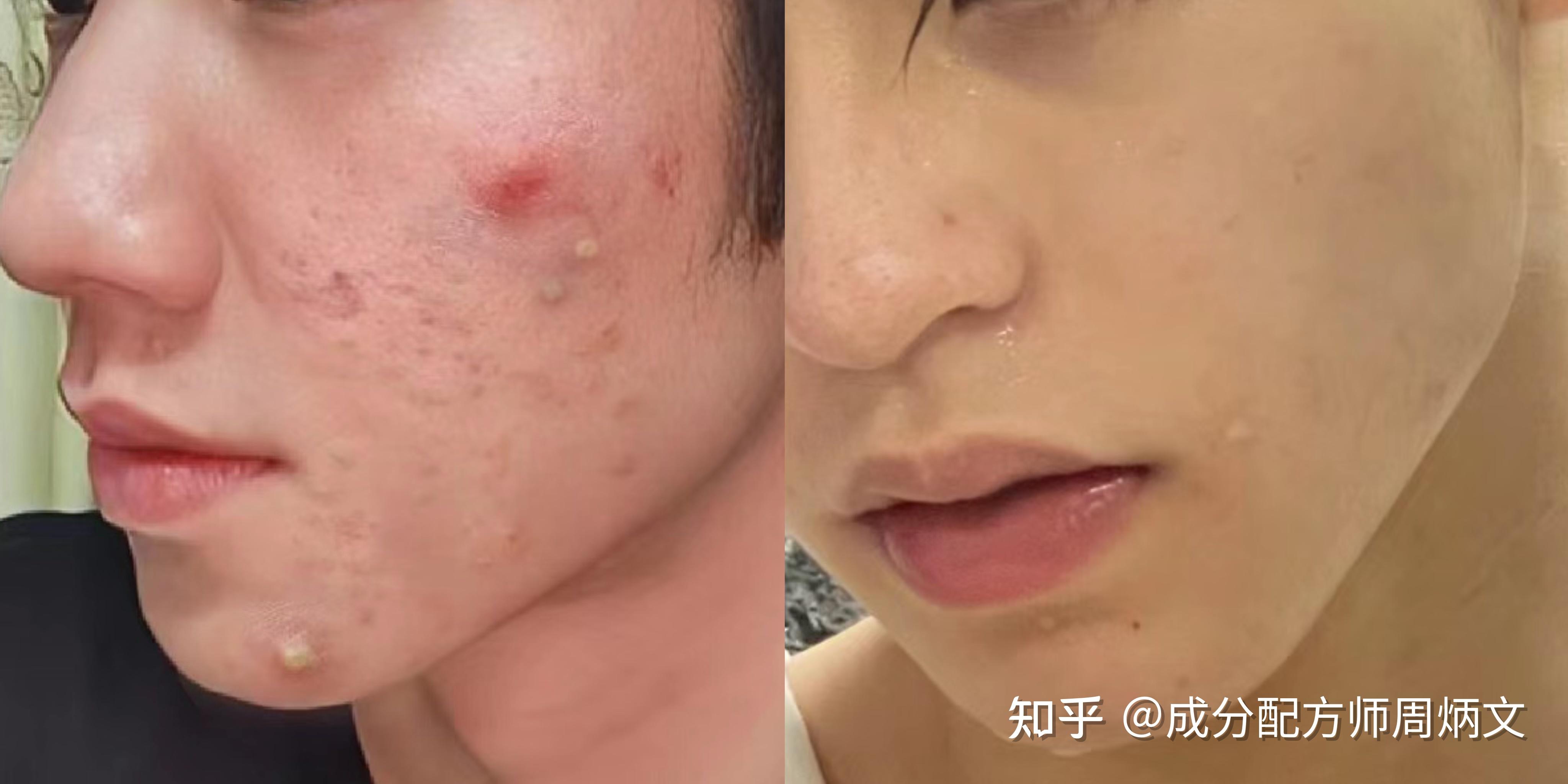 男生脸上痘痘又红又肿，摸起来又硬又痛，还反复不消！一定是你祛痘方法用错了！【专业配方师】教你3招男生正确祛痘方法，让痘痘一扫而光！ - 知乎