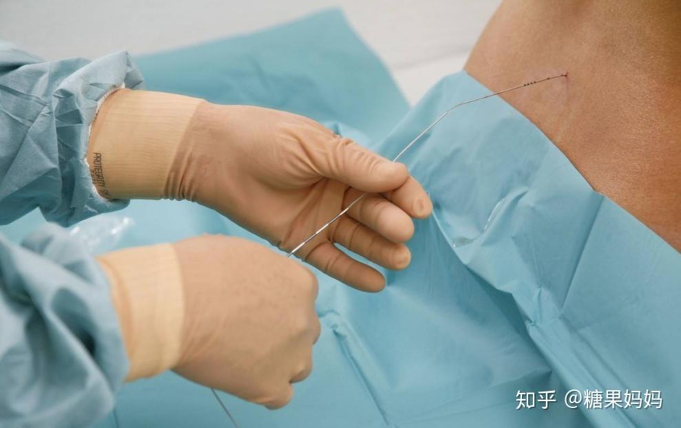 打无痛用通俗一点的话来形容,就是在产妇腰椎上打麻醉,让腰部失去一